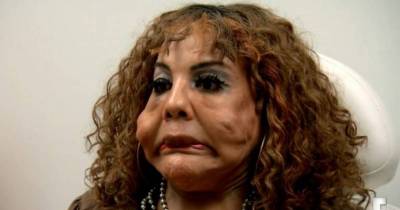 10 Years Ago, She Was Injected With Cement And The Work Done To Fix Her Face Is Incredible