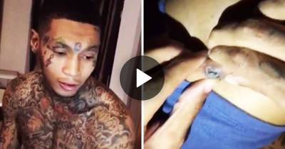 Omg! Dude Squeezes Bullet Out Of His Leg