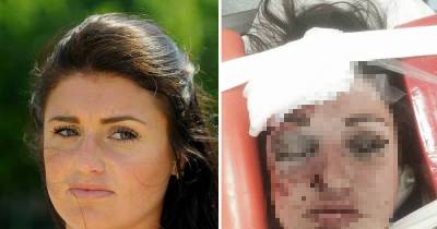 Omg!! Woman Suffered Broken Eye Socket And Was Knocked Unconscious After Being Brutally Attacked By Internet Date