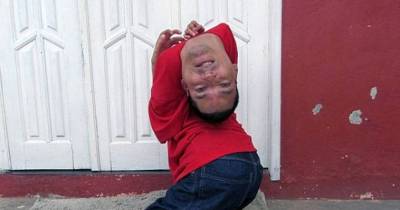 Man With Upside Down Head Is Beating The Odds And Inspiring The World