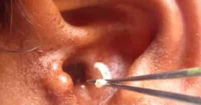 You'll Never Guess What This Man Had Living In His Ear - The Video Proof Will Make Your Skin Crawl