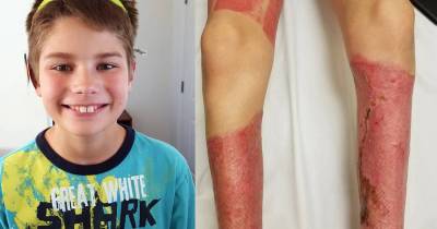 Schoolboy Left With Legs 'Like Raw Meat' After He Was Splashed With Petrol And Set On Fire