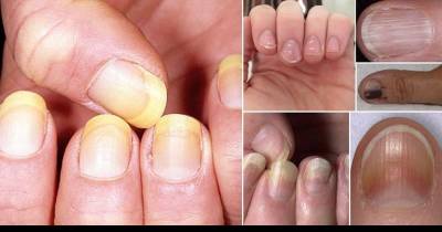 12 Things Your Fingernails Can Tell You about Your Health