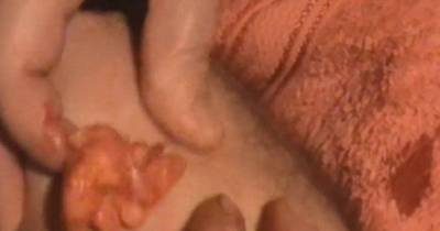 Watch The Hideous Moment This Giant Cyst Explodes And Forms A Huge Ball Of Gunk
