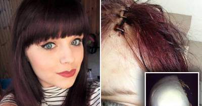 Teenage Student Suffered A Stroke And Had A Third Of Her Skull Removed After Taking A Contraceptive Pill