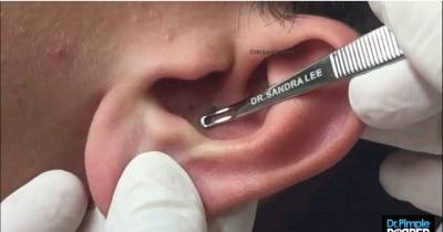 Sounds Gross! Dr Pimple Popper Squeezes Blackheads In A Man&rsquo;s EAR
