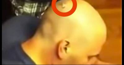 When this man felt an itch at the back of his head, his friends took a look. They found a real life nightmare.