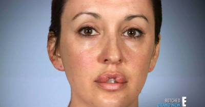 Woman Who Wanted Lips Like Angelina Jolie Had Botched Op... And Was Left Unable To Close Her Mouth