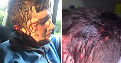 Horrific Injuries Of Bloodied Schoolboy, 16, Attacked By Gang Of Eight With Hammers And Metal Bars