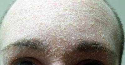 Woman&rsquo;s Face Falls Off After Stopping Use Of Acne Cream