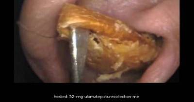 What He Found In His Ear... How Did That Even Fit???