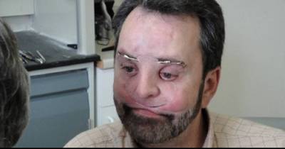 This Man Got A New Face After Losing His Nose And Upper Jaw To Cancer