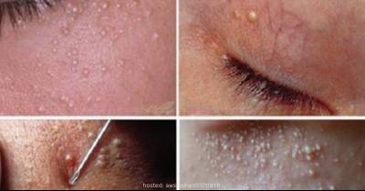 Three Easy Methods To Get Rid Of These Annoying White Skin Cysts