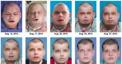 14 Years Ago, Fireman Had His Face Burned Off. Wait Until You See What He Looks Like Today