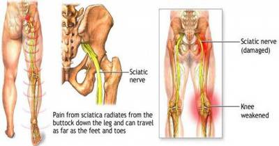 This Is How You Can Heal Sciatic Pain Naturally