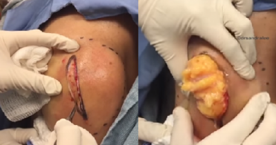 Woman Has Melon-sized Ball Of Fat Chopped From Her Shoulder, This Is The Nopest Video To Date