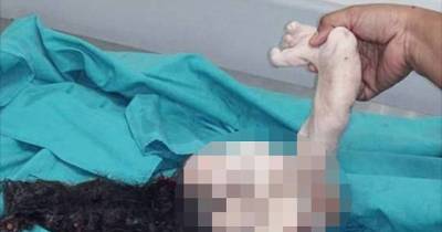 Teenager Has His Unborn Twin Removed From His Stomach After 15 Years