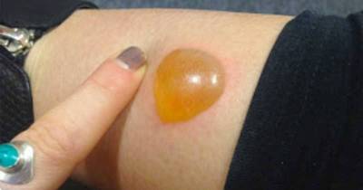 Mysterious Blister Has The Girl Rushing To The ER With &lsquo;Absolutely Unbelievable&rsquo; Pain