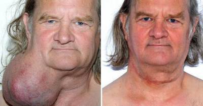 Man Lived With Massive Tumour On His Neck For More Than 20 Years