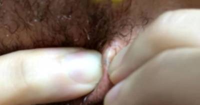 Man Yanks Painful Ingrown Hair From Beard With Needle In Gruesome Video