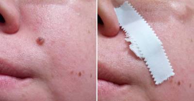 She Taped This On Her Mole And It Disappeared In 5 Days