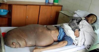 8 Most Horrible Tumors