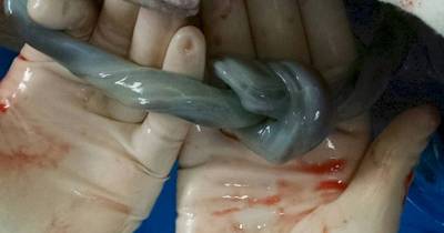 Knotted Umbilical Cord Didn't Stop This Healthy Baby's Birth