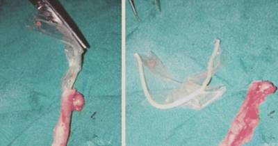 Woman Had Severe Pain In Her Appendix, What Doctors Found Inside Will Shock You