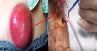 This Man Was Diagnosed With A Sebaceous Cyst But Found Something Much More Sinister After It Was Removed