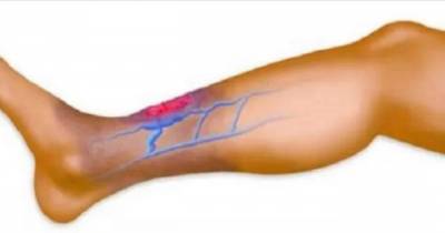 Do You Suffer From Poor Circulation? Here It Is How To Solve The Problem In Only 30 Minutes!