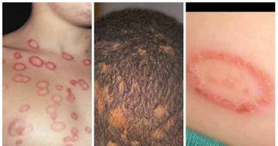 The DIRTY Truth Behind Ringworms Most People Don&rsquo;t Know
