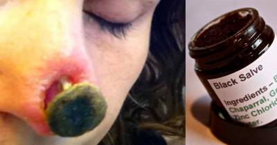 Woman Left With Massive Hole In Her Nose After Using Herbal Treatment She Though Would Cure Skin Cancer