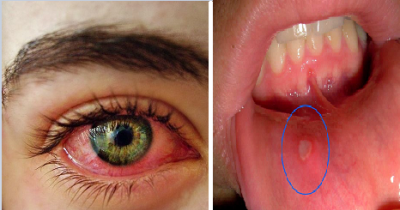 Here's A Natural Treatment For Painful Ailments Like Pink Eye And Canker Sores