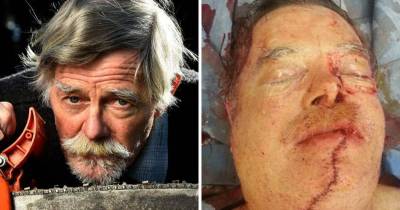 Man Drives Himself To The Hospital After Taking A Chainsaw To The Face