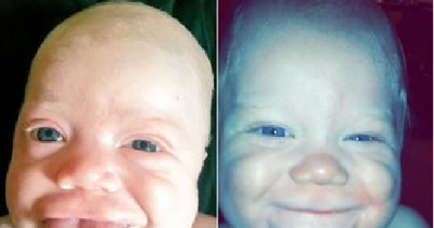 Baby Smiles For First Time After Life-changing Operations To Fix Huge Tongue That Permanently Sticks Out