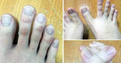 Woman With Toes Like Fingers Freaks Out The Entire Internet