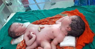 A Mother Had No Idea She Was Carrying Conjoined Twins, Despite Thorough Check-ups During Her Pregnancy Including Ultrasounds