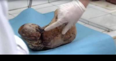 Doctors Believe That It's A Tumor. But What They Cut From Her Body Is Even More Shocking