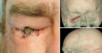 This Man Miraculously Survived From Major Damages After A Nail Accidentally Wedge On His Eye