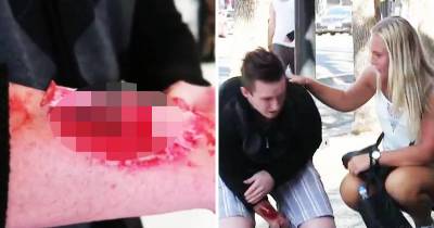 Prankster Scares People with Realistic Broken Arm