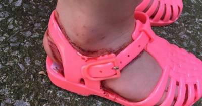 These Popular Toddlers' Shoes Turned A Little Girls' Feet Into A Bloody Mess