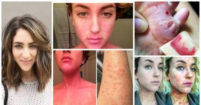 American Actress Ciena Nelson Reveals Grueling Tale Of Her Skin Disease