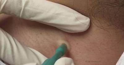 Dr Pimple Popper Removes Gross Three-Year-Old Cyst From Woman's Neck Using 'Hole Punch'