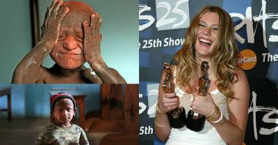 Boy With Rare Condition That Hardens His Skin Has A New Hope For Treatment, Thanks to Joss Stone The British Singer Joss Stone