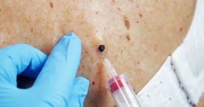 Huge Blackhead Leaves Gaping Hole After Being Removed From Woman&rsquo;s Back