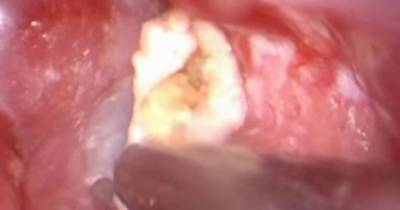 Gut-wrenching Footage Shows Doctor Remove Enormous Lump Of Ear Wax And Keratin From Ear