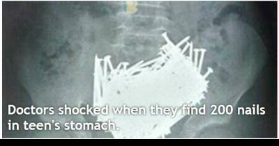 Doctors Shocked When They Find 200 Nails In Teen's Stomach.