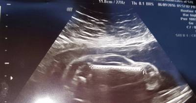 Pregnant Woman Stunned To Find Baby Who Looks Just Like A CAR In Her Ultrasound Scan