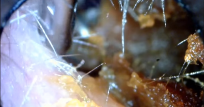 OMG!! The Worlds Biggest Ear Wax Removal Ever!!! Unbelievable What Comes Out