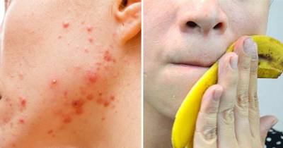 She Rubs A Banana Peel On Her Face And This Happens To Her Acne